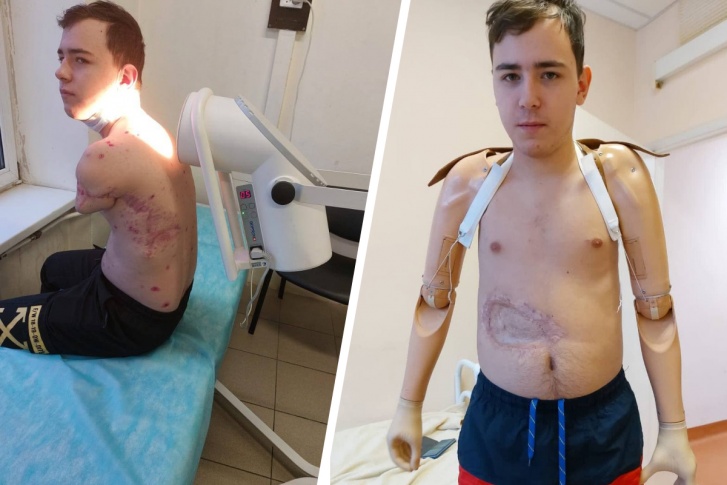 Мальчик лишился рук после ЧП на подстанции Мальчик лишился рук после ЧП на подстанции