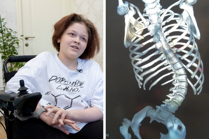 Оле нужна хирургическая коррекция позвоночника Оле нужна хирургическая коррекция позвоночника