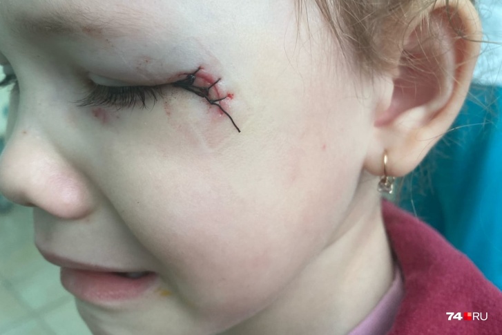 Девочке наложили три шва на рану у глаза