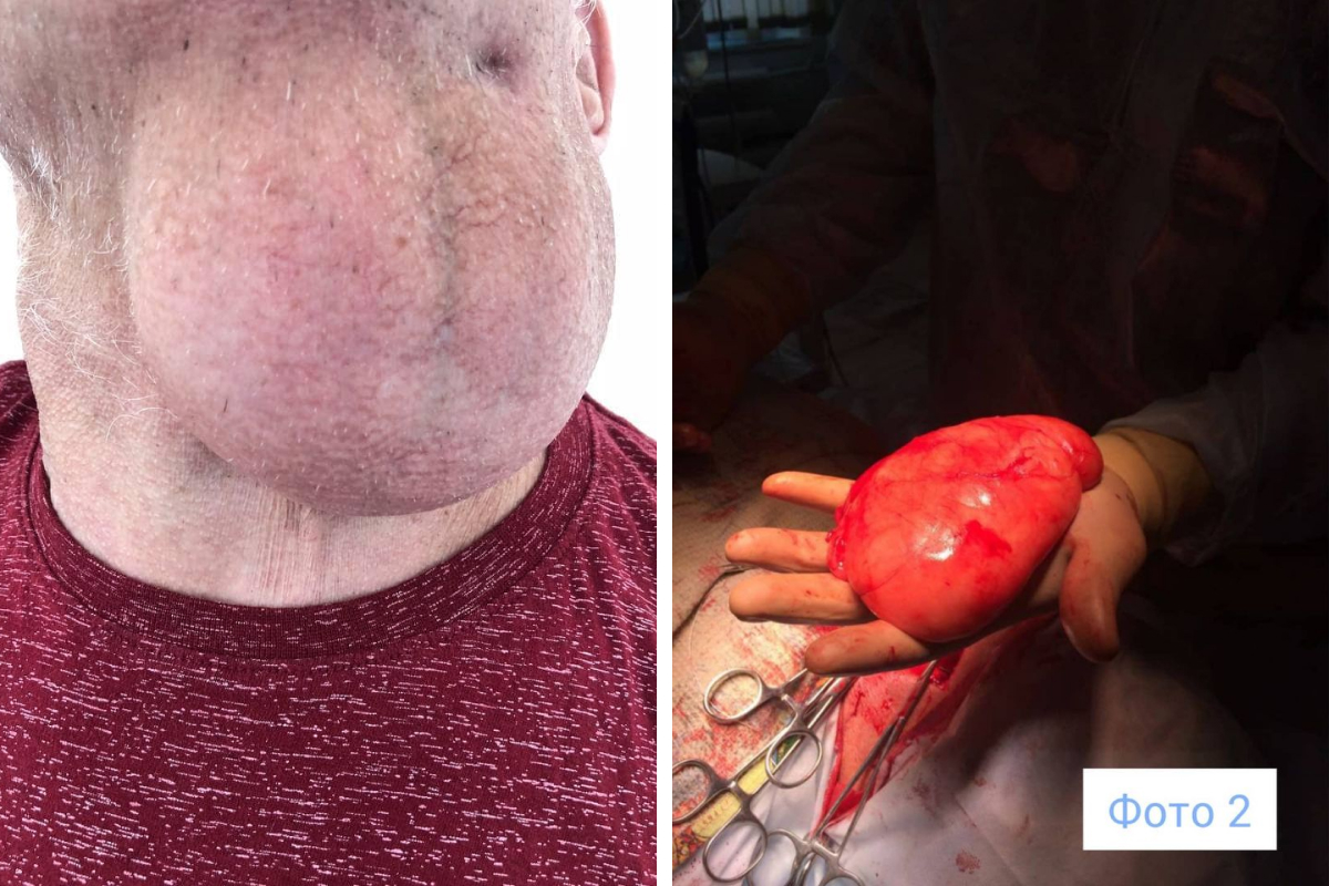 Красноярец 10 лет жил с гигантской опухолью на шее. Ее удалили в БСМП