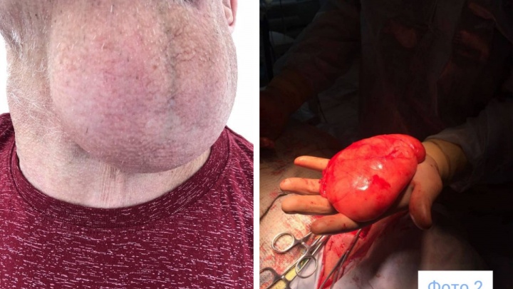 Красноярец 10 лет жил с гигантской опухолью на шее. Ее удалили в БСМП