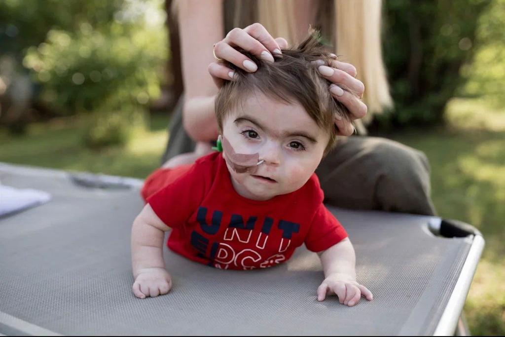 Дети с синдромом Корнелии де Ланге рождаются с густыми волосами, длинными ресницами и бровями
