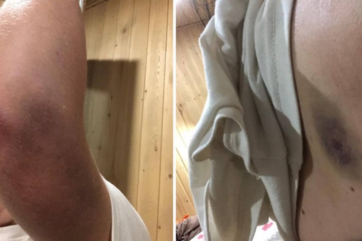 Девушка выложила в соцсети фотографии синяков Девушка выложила в соцсети фотографии синяков