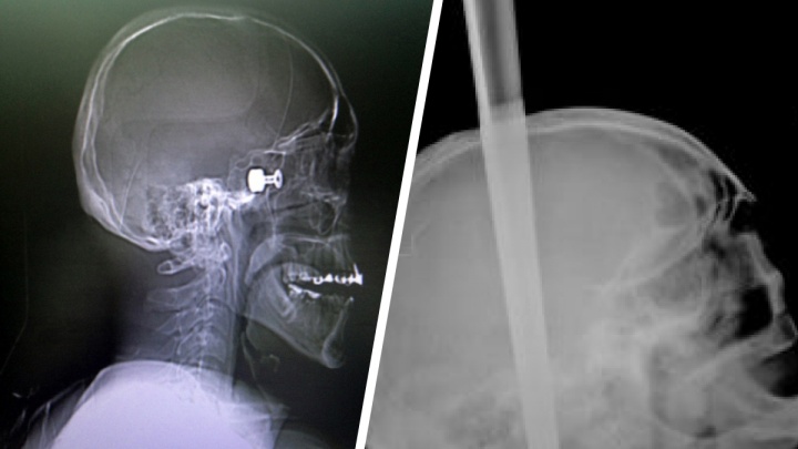 Рваные раны медведя, ножка от табурета в черепе: пять невероятных травм, после которых пострадавшие выжили