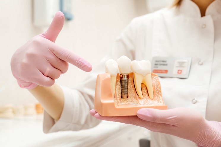 Врачи «Семейной стоматологической клиники» в совершенстве владеют всеми видами имплантации