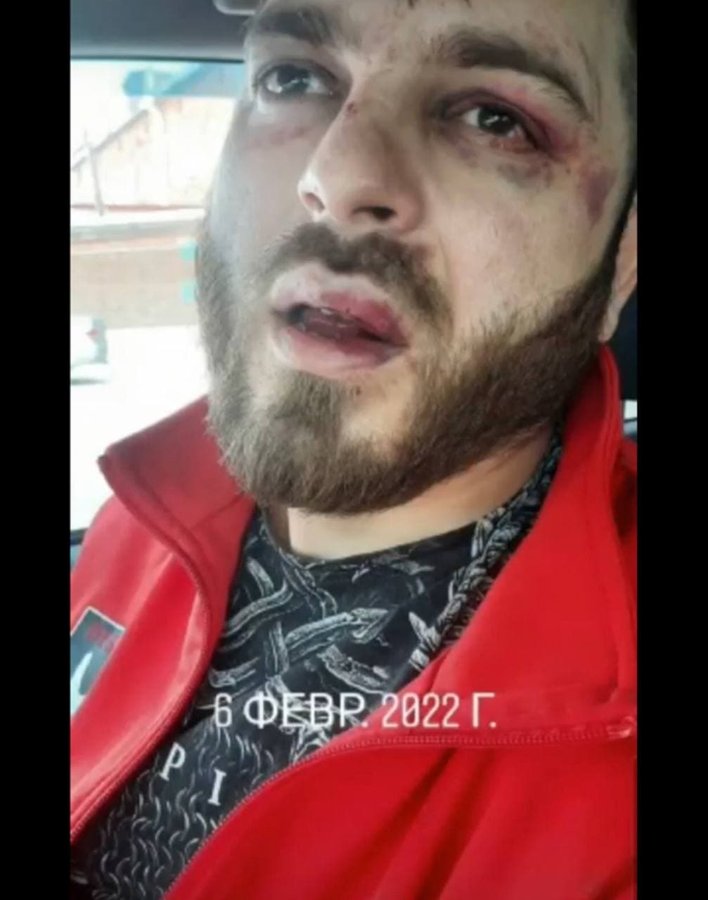 Байрамов через пару дней после драки Байрамов через пару дней после драки