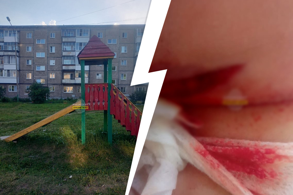 «Нужна операция». На Урале маленькая девочка разрезала ягодицы, напоровшись на гвоздь в горке