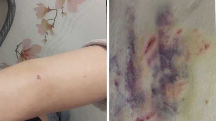 «Я лежала на земле и кричала»: педиатр с Сортировки рассказала о нападении собаки во время вызова