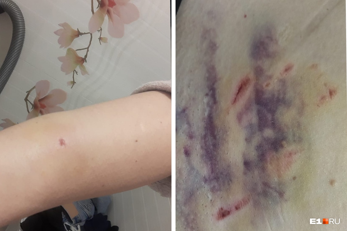 «Я лежала на земле и кричала»: педиатр с Сортировки рассказала о нападении собаки во время вызова