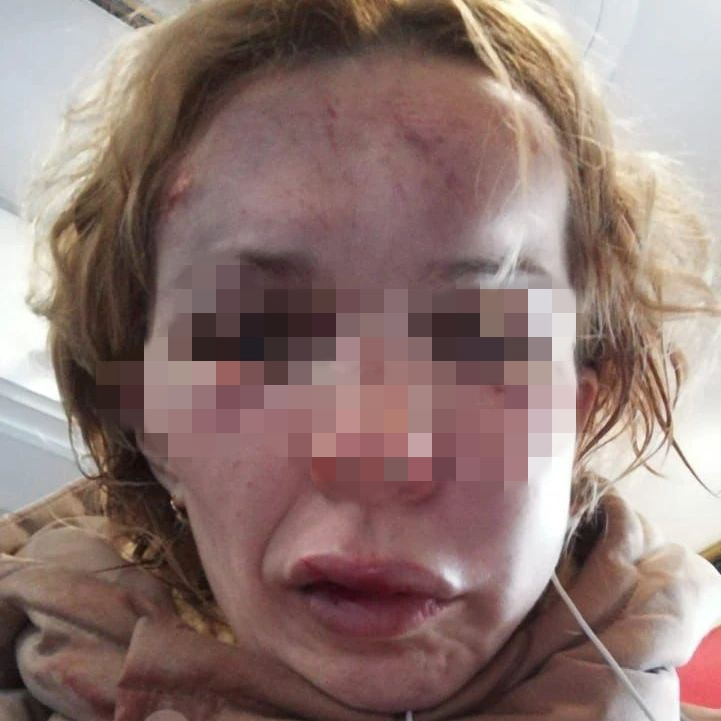Так выглядит Ирина В. после избиения Так выглядит Ирина В. после избиения