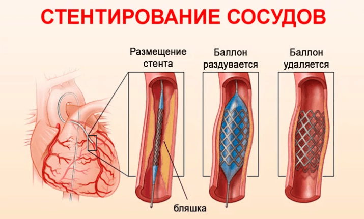 Установка стента — ювелирная работа Установка стента — ювелирная работа