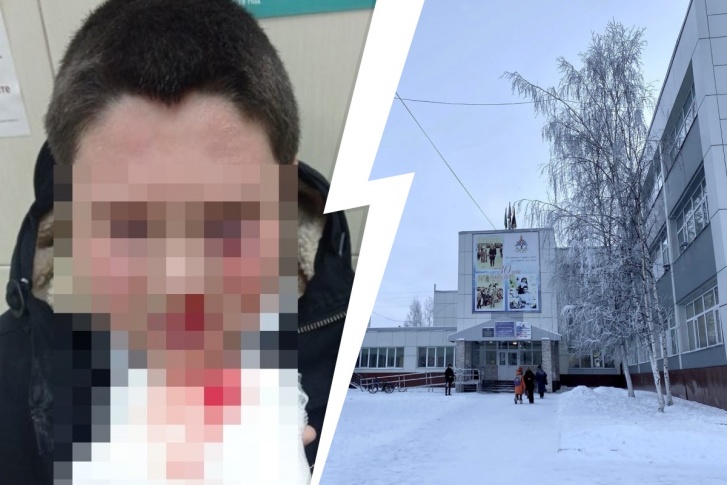 Из-за агрессивного одноклассника ребенок едва не лишился глаза Из-за агрессивного одноклассника ребенок едва не лишился глаза