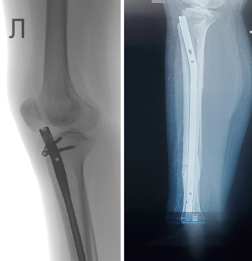 Хирург клиники «РЖД-Медицина» вставил штырь (слева) чуть длиннее, чем требовалось — он упирался в кость и мешал ходить