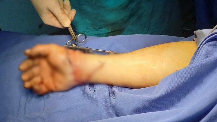 На Кубани мужчине отрезало руку острым листом железа
