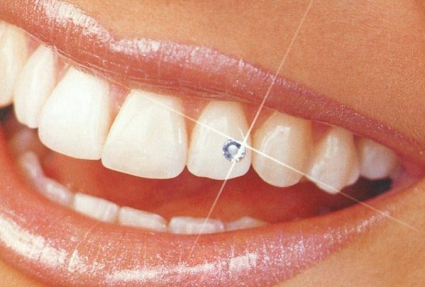 Украшение на зуб подарят в стомклинике при лечении трёх зубов