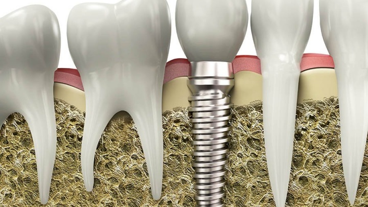 Ликбез: Зубные импланты, их виды, цены и правила выбора