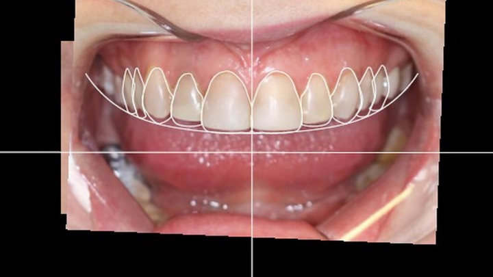 Красивые зубы без фотошопа. Как стоматолог создаёт идеальную улыбку