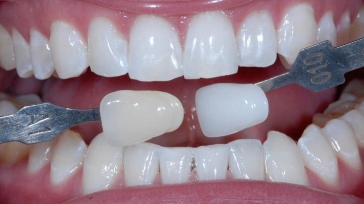 Профессиональное отбеливание зубов до десяти тонов проведёт стоматология «Эсси» в Чите