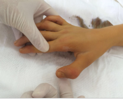 Детская ортопедия: контрактура пальцев
