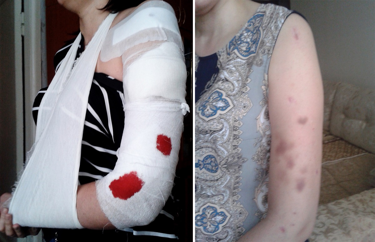 Сейчас женщине предстоит длительное восстановление подвижности руки Сейчас женщине предстоит длительное восстановление подвижности руки