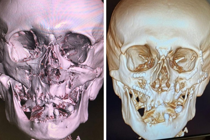 На снимке справа видно, как металлоконструкции соединяют части раздробленного лица