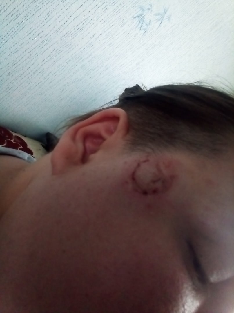 У девушки опухла половина лица У девушки опухла половина лица