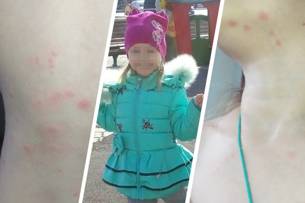 Расчесанные пятна мать заметила на дочери в тот же день, как забрала ее домой из приюта Расчесанные пятна мать заметила на дочери в тот же день, как забрала ее домой из приюта