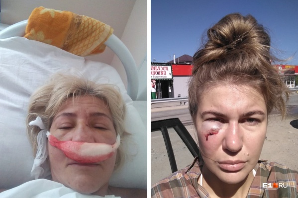 В драке женщине сломали нос, а у ее дочери — гематома В драке женщине сломали нос, а у ее дочери — гематома