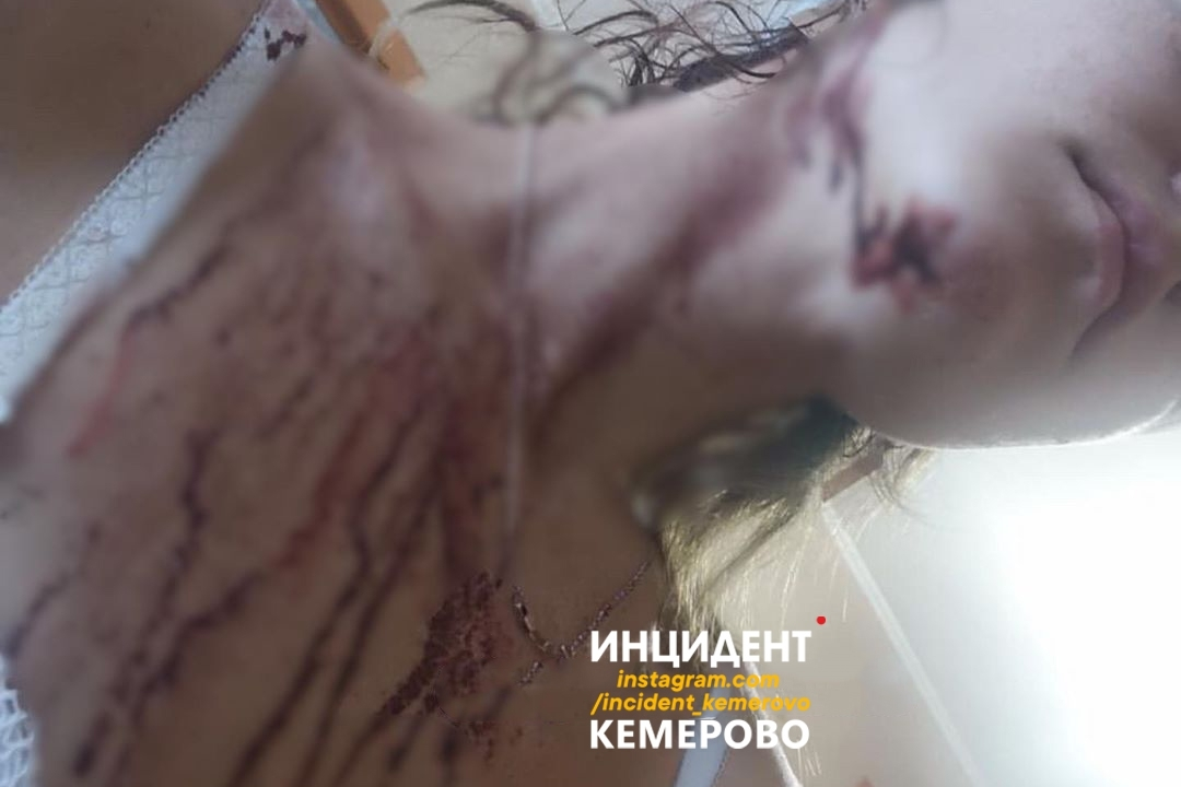 Врачи предварительно оценили причиненный ее здоровью вред как легкий Врачи предварительно оценили причиненный ее здоровью вред как легкий