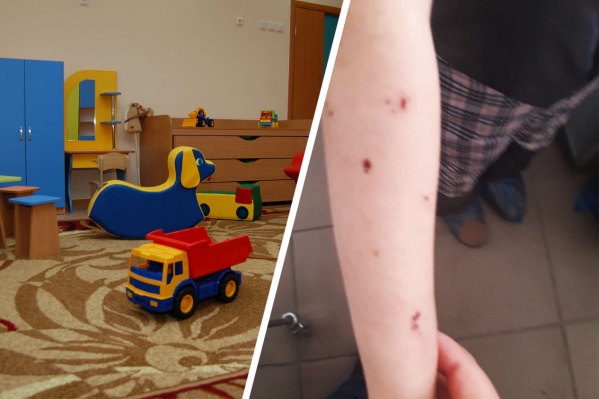 Такие следы обнаружили на коже одной из девочек. В детсаду уверены, что это следы от укусов насекомых Такие следы обнаружили на коже одной из девочек. В детсаду уверены, что это следы от укусов насекомых