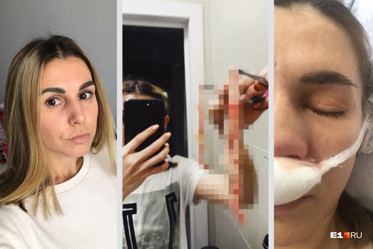 Этот бинт у девушки должны были удалить еще пять дней назад, в день выписки Этот бинт у девушки должны были удалить еще пять дней назад, в день выписки