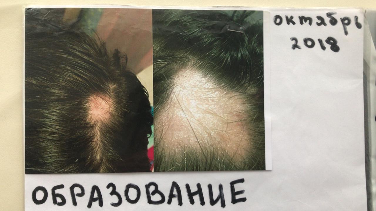 Все началось с небольшой залысины на макушке Все началось с небольшой залысины на макушке