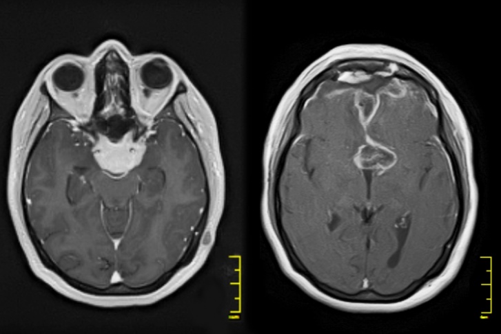 На снимке слева опухоль до операции, справа — после нее