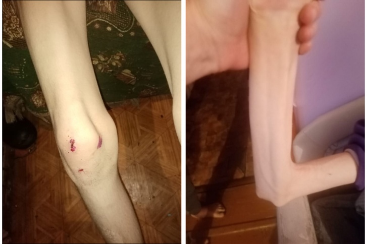 Так выглядели руки и ноги Матвея в тот день, когда его забрали из Ояшинского дома-интерната Так выглядели руки и ноги Матвея в тот день, когда его забрали из Ояшинского дома-интерната