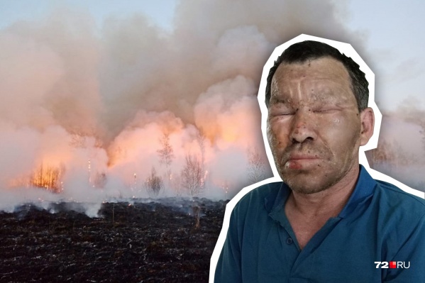 Ришат Каримов получил ожоги. У него пострадали руки и лицо Ришат Каримов получил ожоги. У него пострадали руки и лицо