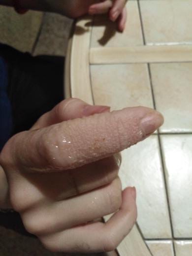 Палец покрылся волдырями после обращения в больницу