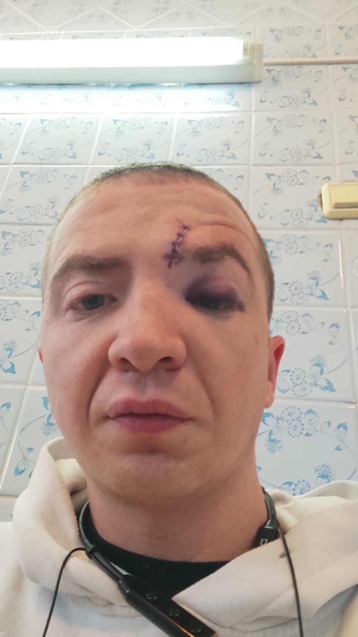У Андрея множество ушибов. На лице гематомы и рассечение У Андрея множество ушибов. На лице гематомы и рассечение