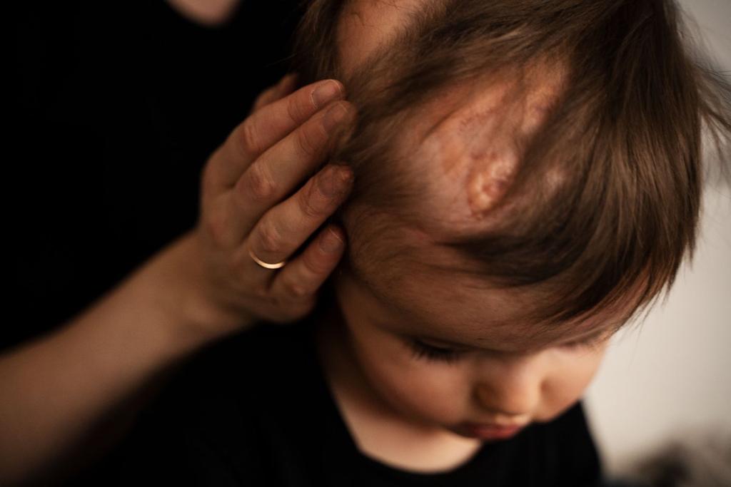 Сразу после рождения на голове мальчика врачи увидели пятна. Как выяснилось, это была аплазия