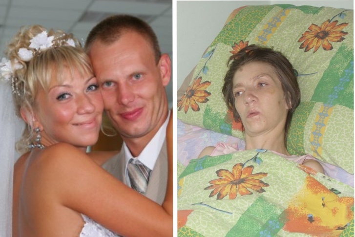 Ирина до трагедии в день свадьбы и после — во время лечения