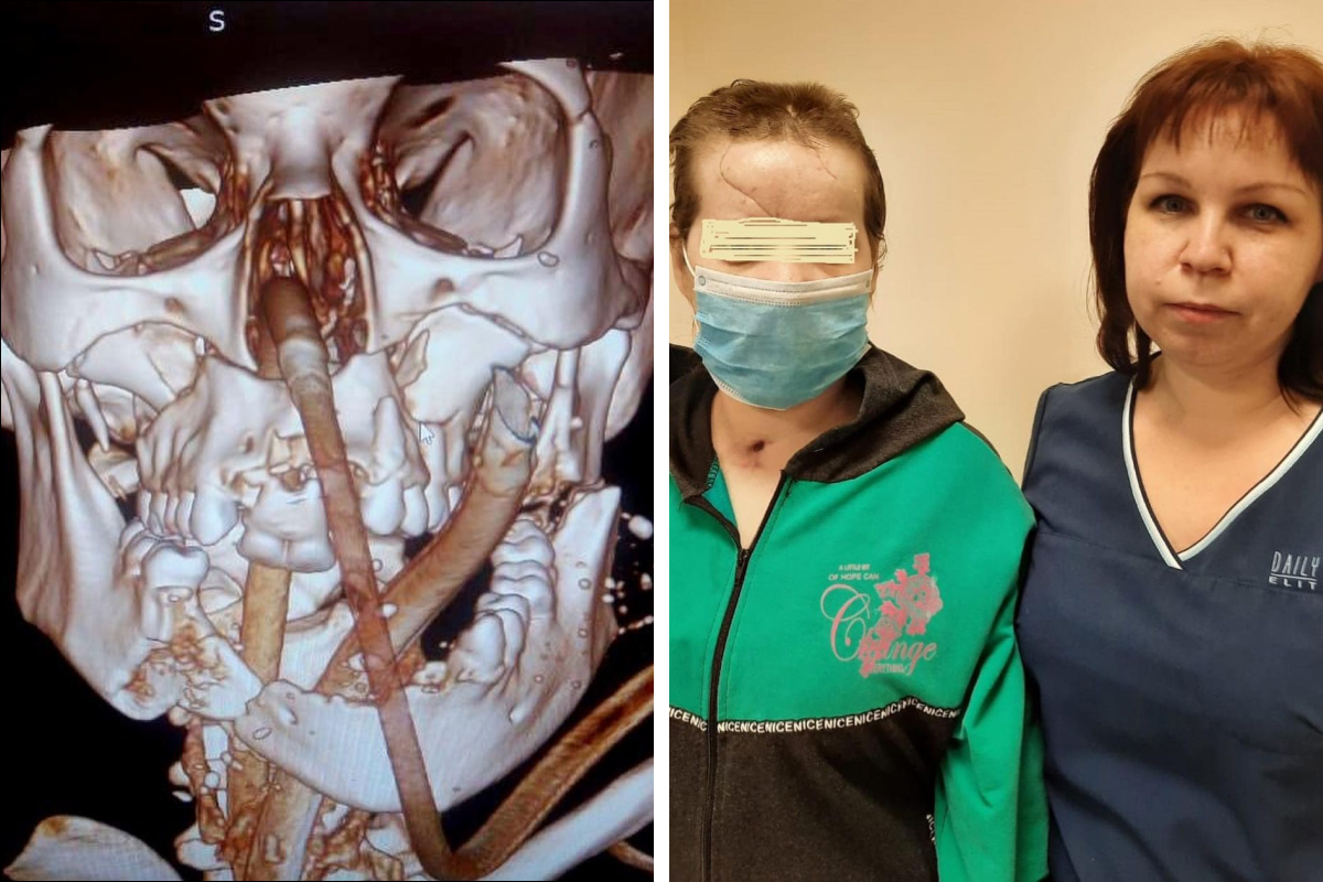Красноярские хирурги спасли лицо женщине, которой в аварии оторвало язык и челюсть
