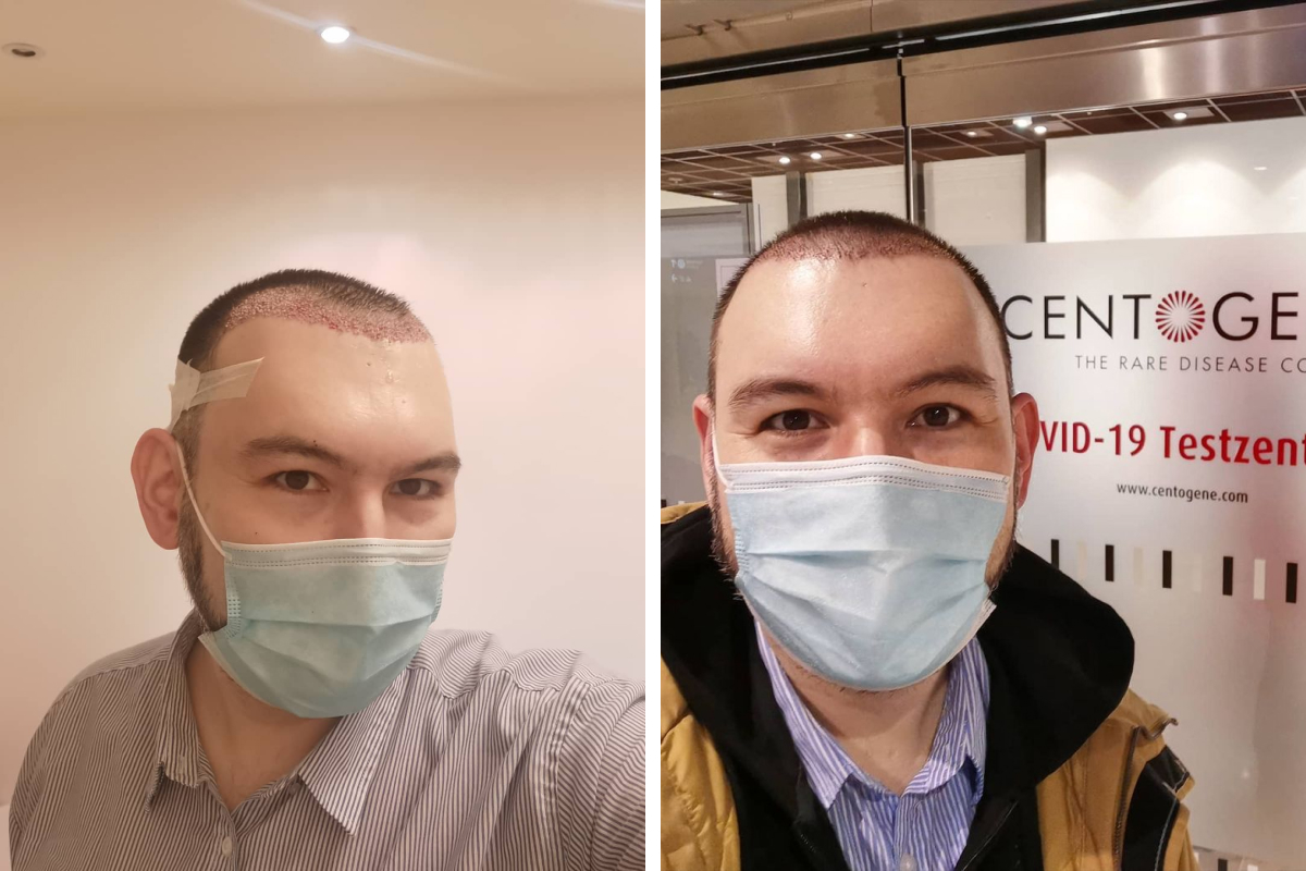 Фото слева — сразу после операции, справа — через несколько дней, заметно, что волосы уже отросли Фото слева — сразу после операции, справа — через несколько дней, заметно, что волосы уже отросли