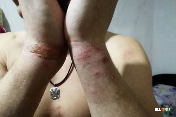 Ссадины от наручников, которые остались на запястьях Максима Ссадины от наручников, которые остались на запястьях Максима