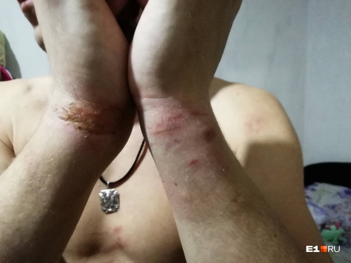 Ссадины от наручников, которые остались на запястьях Максима Ссадины от наручников, которые остались на запястьях Максима