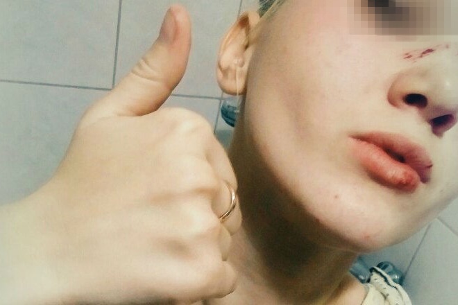 Пострадавшая девушка не поленилась сфотографироваться и выставить снимки в интернете Пострадавшая девушка не поленилась сфотографироваться и выставить снимки в интернете