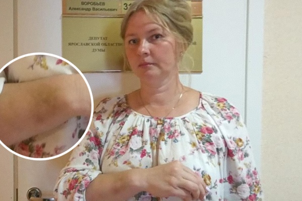 Синяк Татьяны Шаминой спустя четыре дня, как ей скрутили руки Синяк Татьяны Шаминой спустя четыре дня, как ей скрутили руки