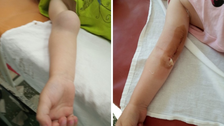 Хирурги двух больниц удалили огромную шишку, образовавшуюся после перелома на руке мальчика
