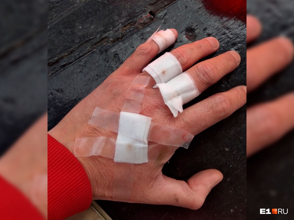 В таком виде была рука Оксаны после нападения пассажира В таком виде была рука Оксаны после нападения пассажира
