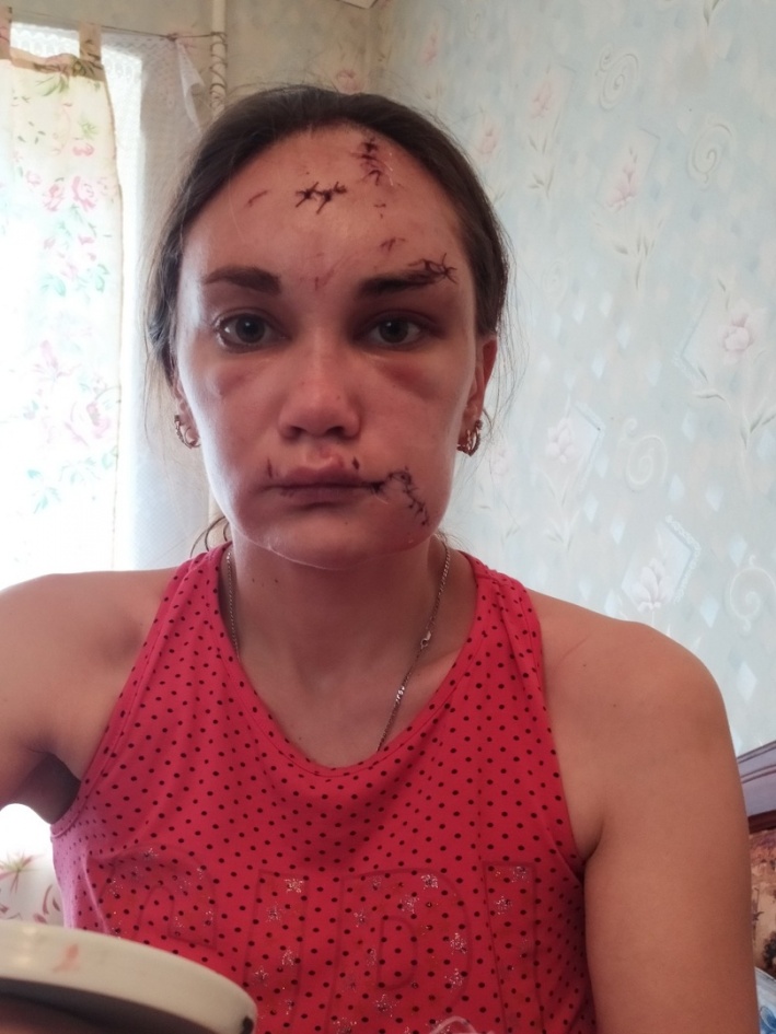 Ирина после побоев Ирина после побоев