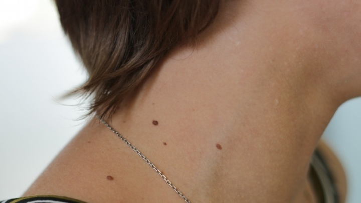 Опасные родинки: как отличить рак кожи от меланомы