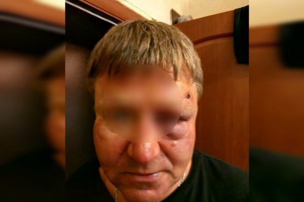 У мужчины опухло лицо из-за побоев<br><br> У мужчины опухло лицо из-за побоев<br><br>